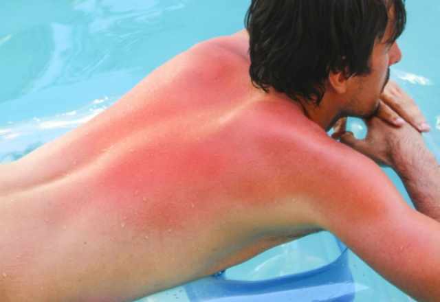 Sunburn prevention tips