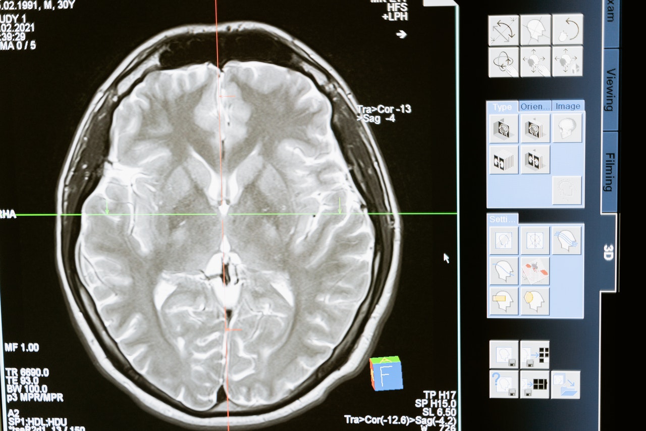 Parkinson's disease