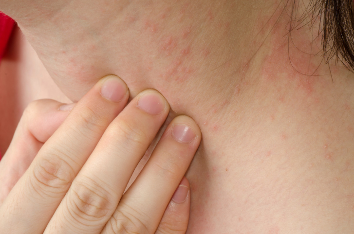 Navigating the World of Eczema