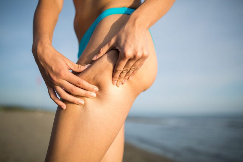 CelluAid: The Ultimate Solution for All Types of Cellulite