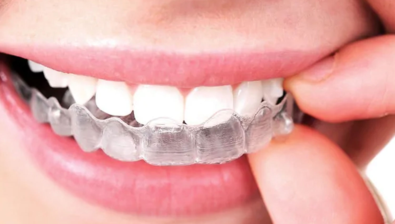 Invisalign Procedure Charges in Winnipeg